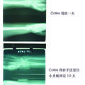 Colles骨折臨床治療32例  