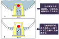 使輸液自動(dòng)停止的藥瓶瓶塞