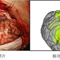 基于顱內(nèi)腦電的高精度腦功能映射與神經(jīng)監(jiān)護系統(tǒng)