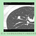 困難肺結(jié)節(jié)容積定量分析系統(tǒng)