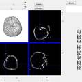 基于顱內(nèi)腦電的高精度腦功能映射與神經(jīng)監(jiān)護(hù)系統(tǒng)